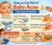 How to Get Rid of Baby Acne: Fast, Safe Remedies